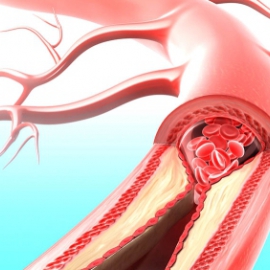 Doenças da aorta e aneurismas da aorta torácica 