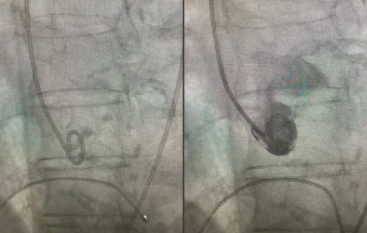 Inovação em cardiologia: implante transcateter com a prótese Braile SafeSync 24 mm